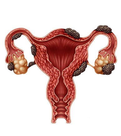 ¿Es la endometriosis una enfermedad genética?